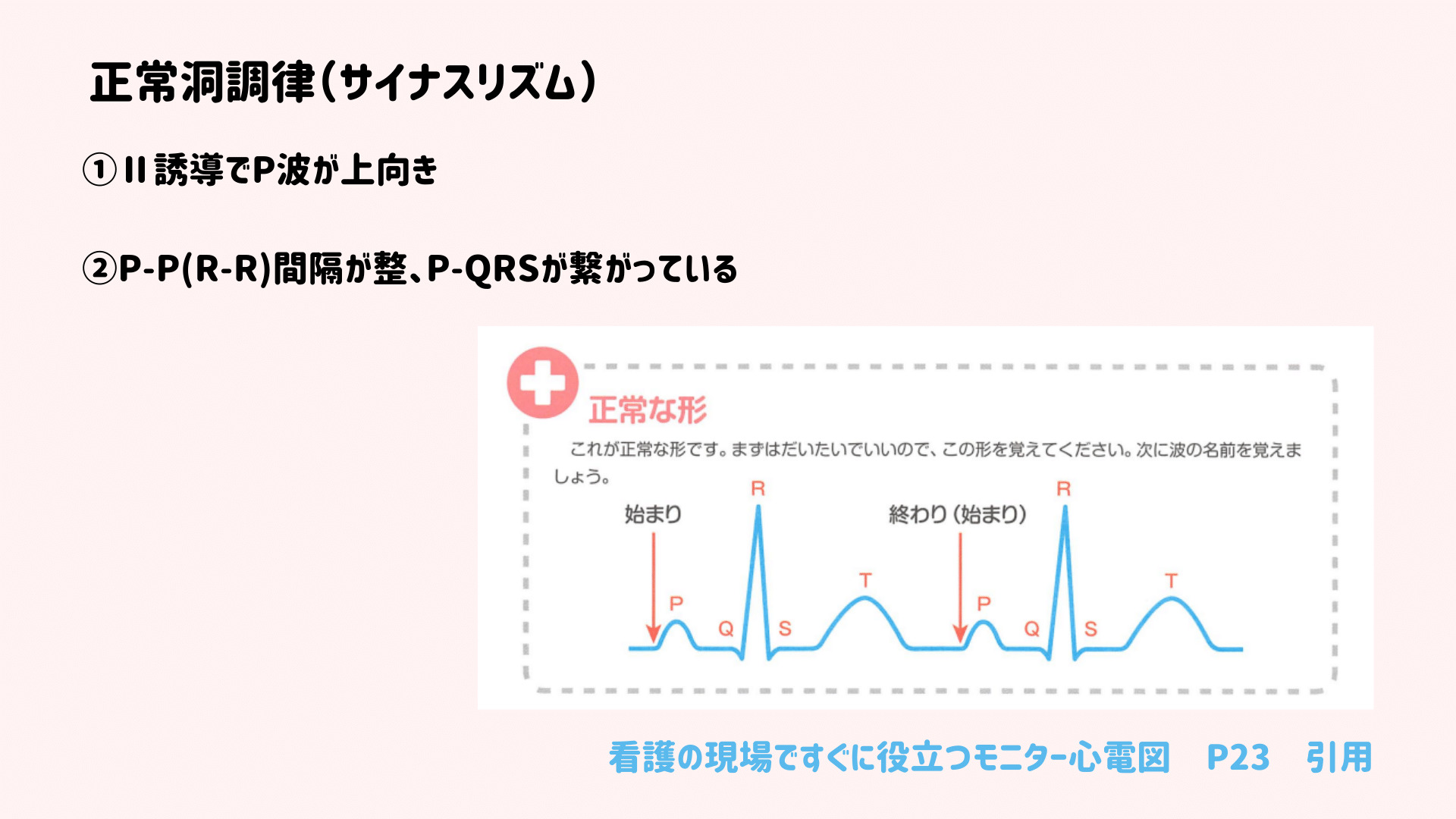 NSR or SRの定義を知りたい。心電図の正常洞調律、洞調律、サイナスリズムについて｜ぴのまるさん